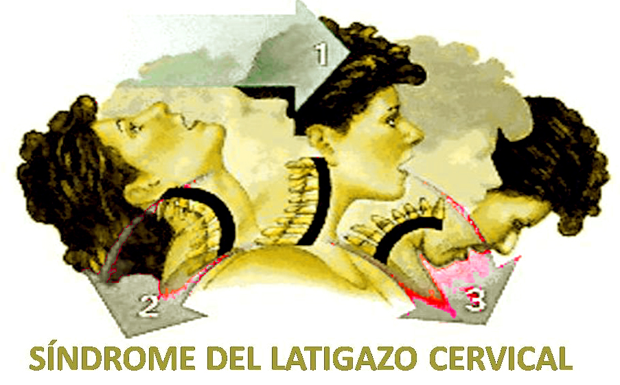 latigazo cervical - valoracin dao corporal